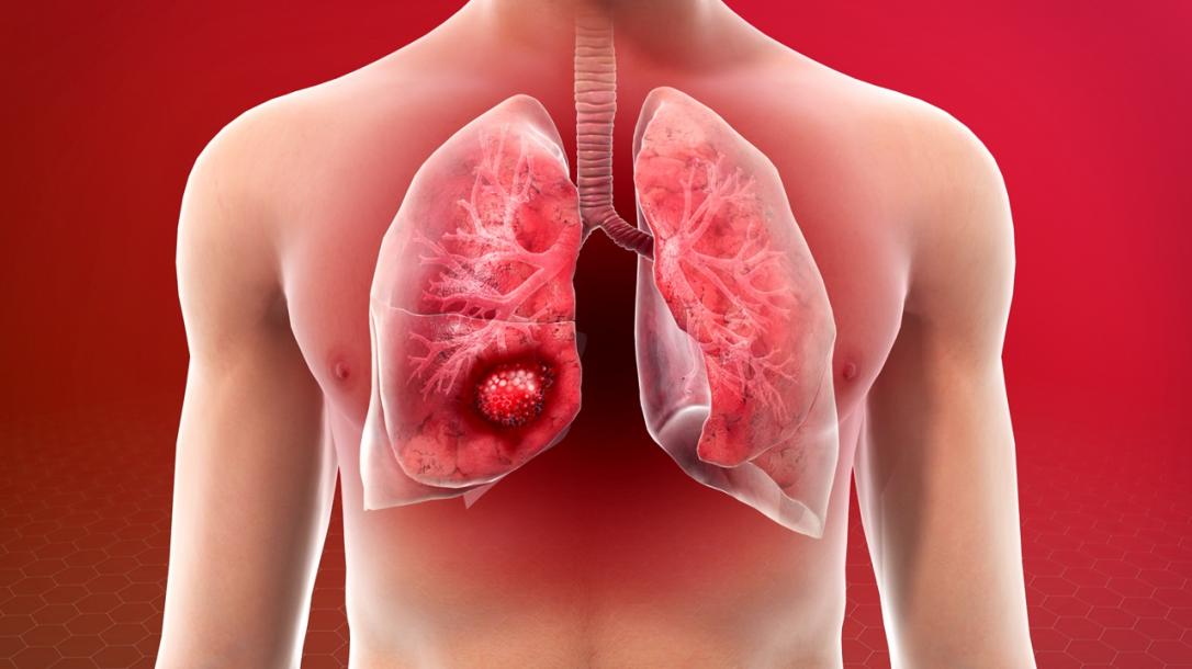 10 Soruda Akciğer Kanseri